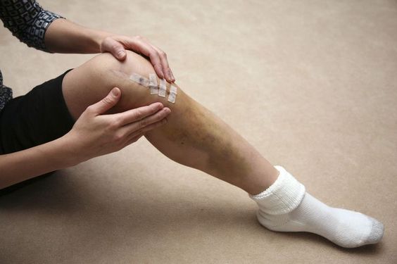 ACL Reconstruction Surgery