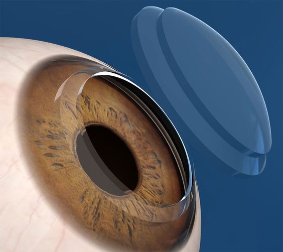Corneal transplant