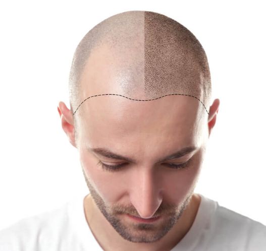 Hair transplantation