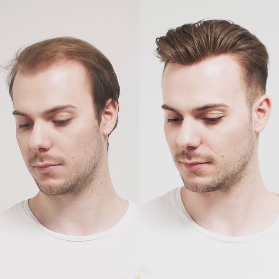 Hair transplantation
