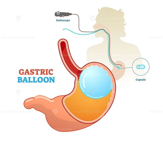 Gastric balloon