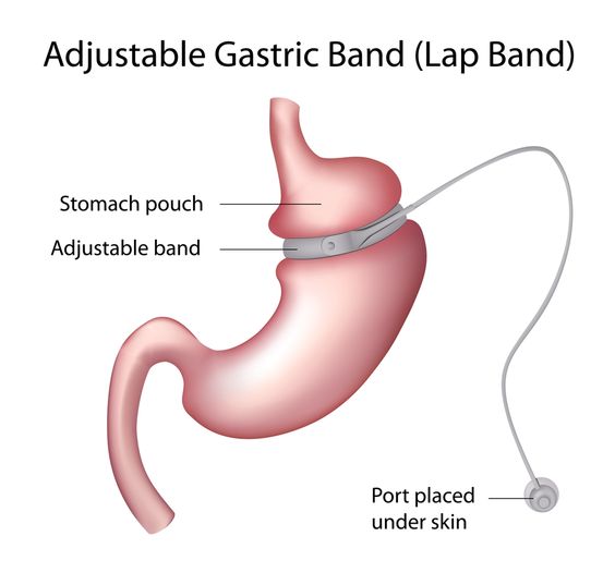 Gastric band