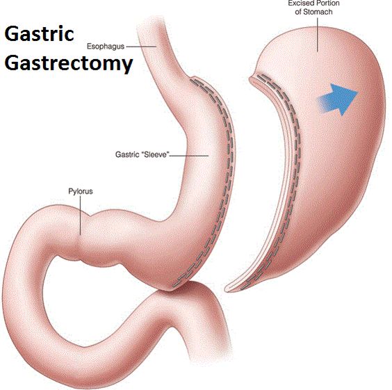 sleeve gastrectomy