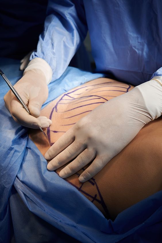 Revisional Bariatric Surgery